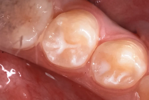 Герметизация фиссур