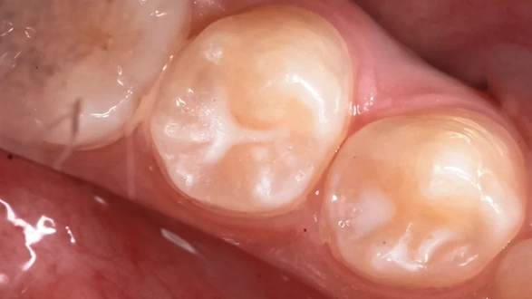 Герметизация фиссур