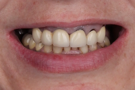 Отсутствие зубов в жевательном отделе