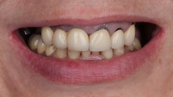 Отсутствие зубов в жевательном отделе