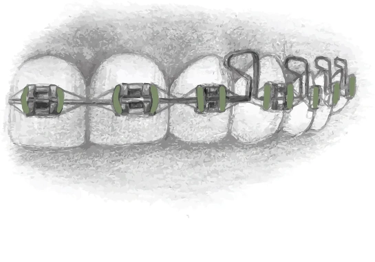 Брекеты и элайнеры