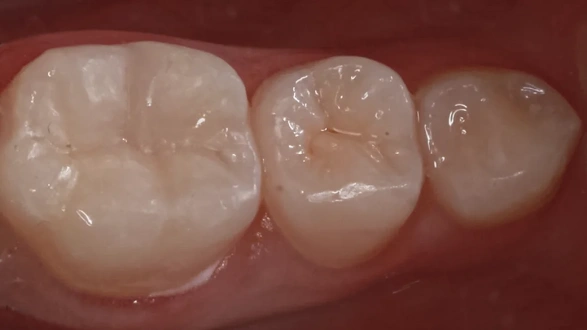 Лечение зуба у ребенка 