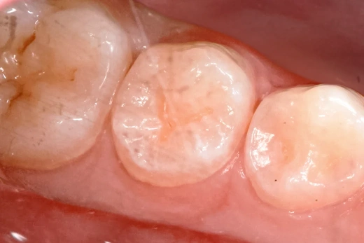 Герметизация фиссур