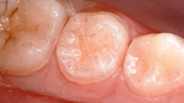 Герметизация фиссур