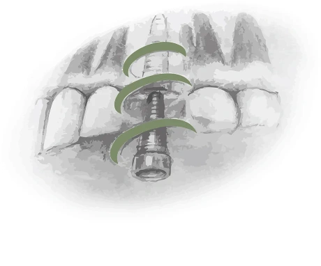 Имплантация