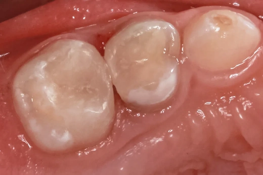 Лечение кариеса у ребенка