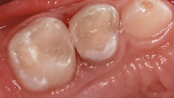 Лечение кариеса у ребенка