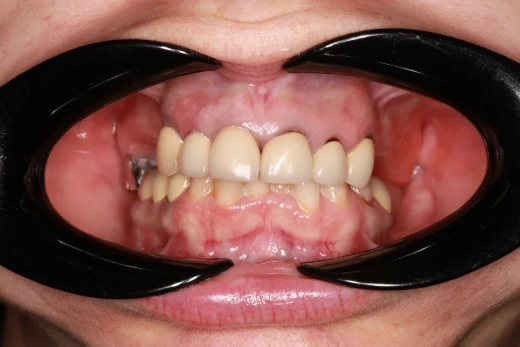 Отсутствие зубов в жевательном отделе