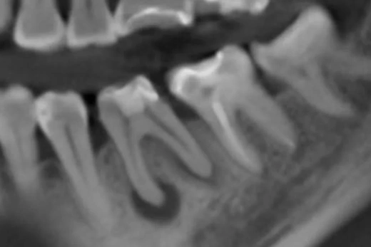 Сохранение и восстановление зуба 