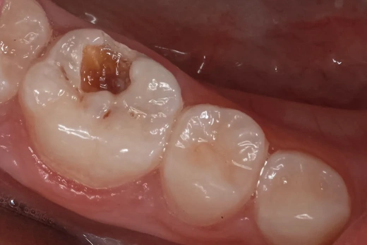 Лечение зуба у ребенка 