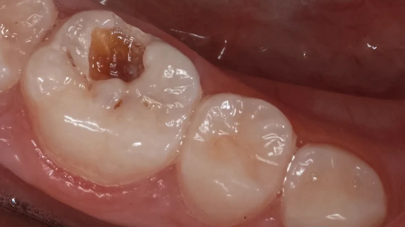 Лечение зуба у ребенка 