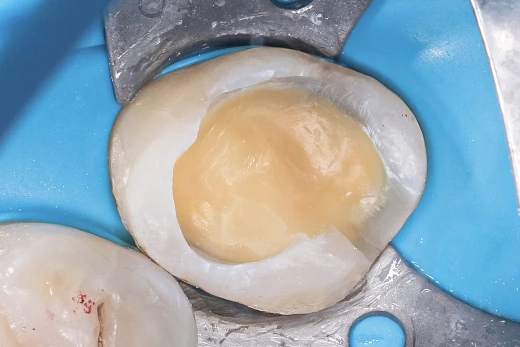 Сохранение и восстановление зуба 