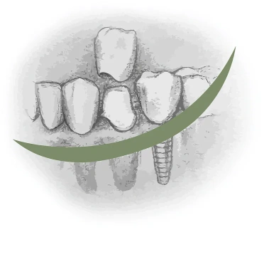 Протезирование зубов