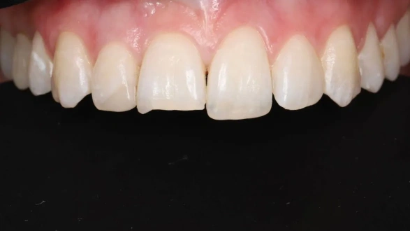 Эстетическая реставрация  11 зуба