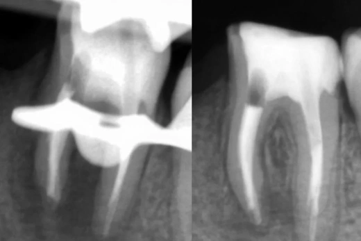 Сохранение и восстановление зуба 