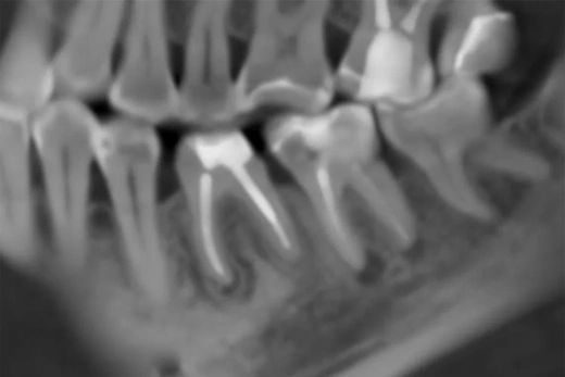 Сохранение и восстановление зуба 