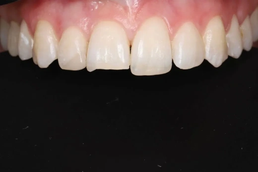 Эстетическая реставрация  11 зуба