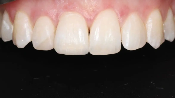 Эстетическая реставрация  11 зуба
