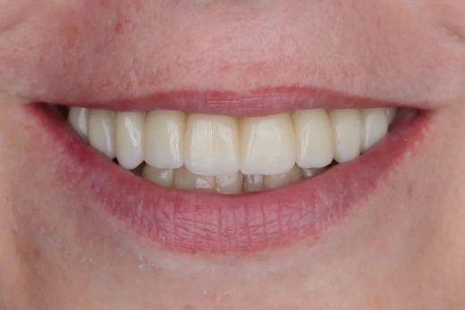 Отсутствие зубов в жевательном отделе