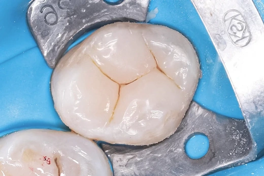 Сохранение и восстановление зуба 