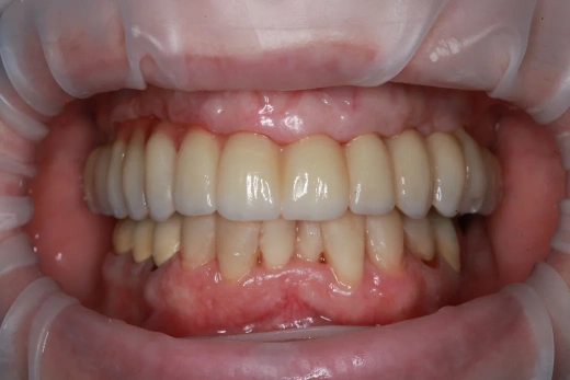 Отсутствие зубов в жевательном отделе