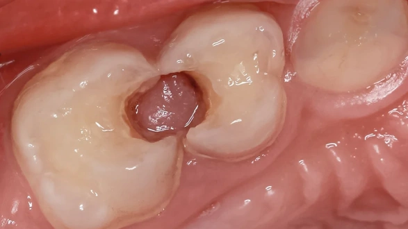 Лечение кариеса у ребенка