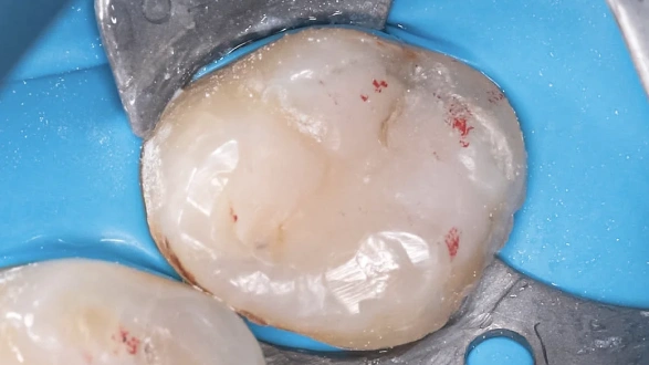 Сохранение и восстановление зуба 